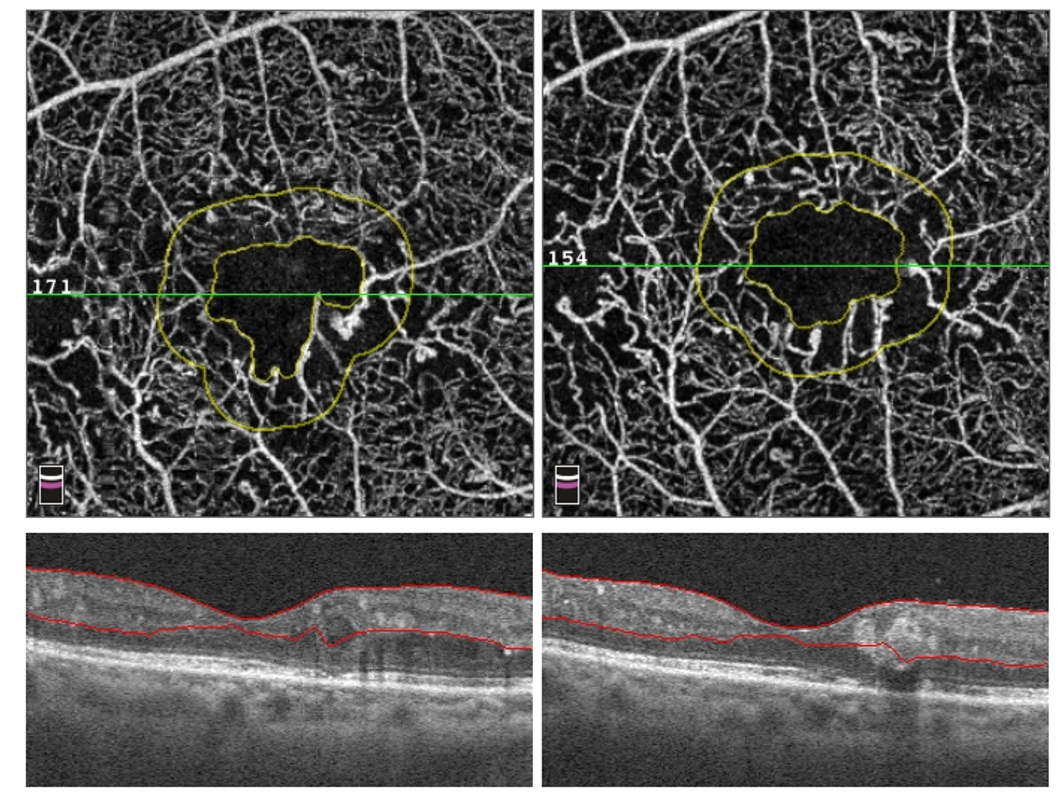 [OCT Observations] OCT-A and Diabetic Retinopathy