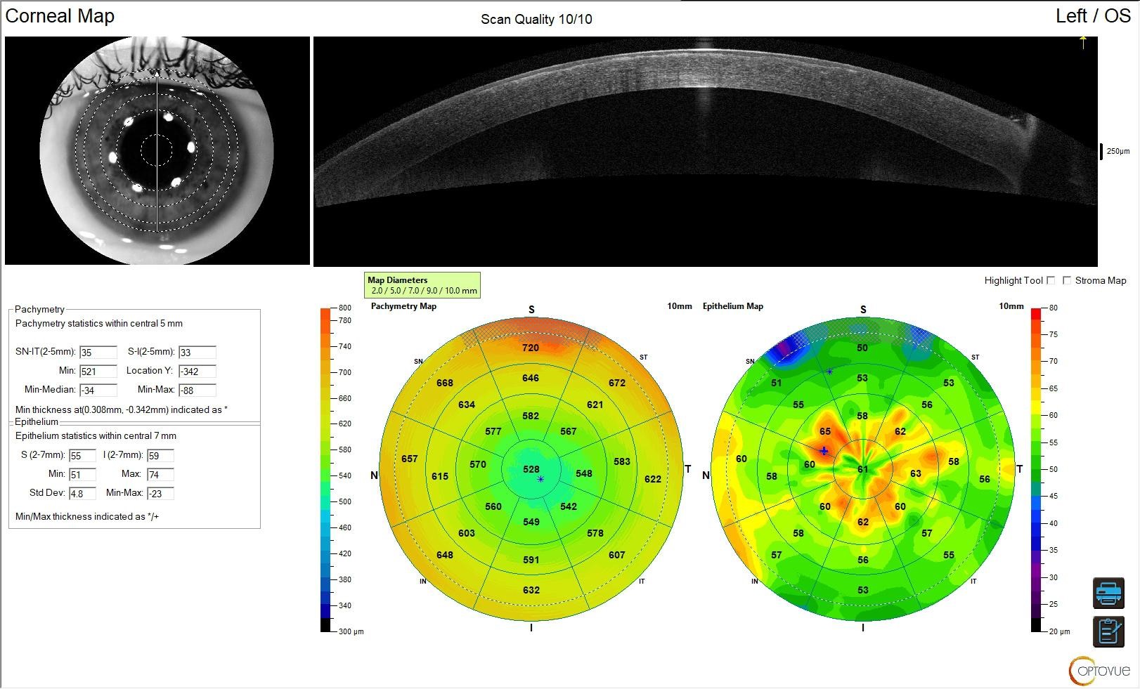 fig. 2 Optovue Solix OCT (Optical Coherence Tomography) appearance, with epithelial mapping. This clearly shows the irregular aspect of the subepithelial stroma and the compensation of the epithelium.