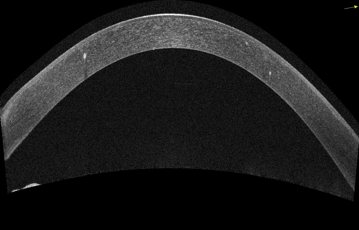 fig. 5. Postoperative appearance on Optovue Solix OCT confirming the almost complete disappearance of subepithelial opacities.