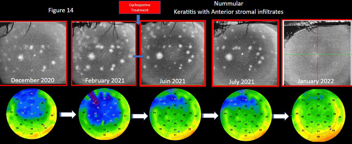 Follow-up of a patient with adenovirus keratitis with its aspects of nummular by OCT