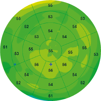 [OCT Observations] Dry Eye multimodal imaging by OCT