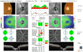 [OCT Artículo] Manejo del riesgo de glaucoma con antecedentes familiares Image