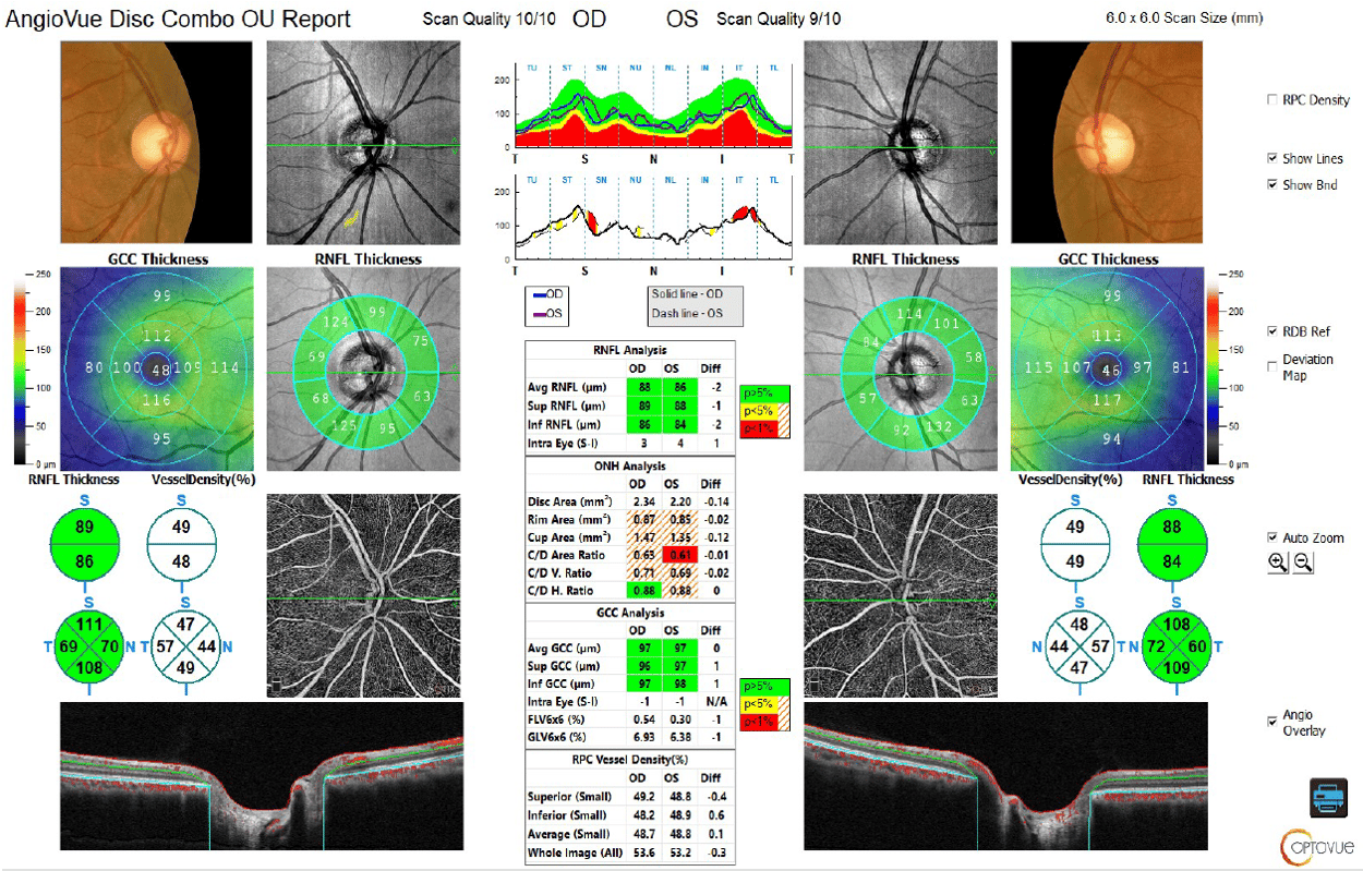 [OCT Article] Managing Glaucoma Risk with Positive Family History Image