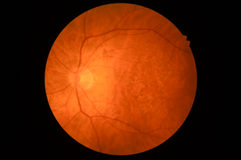 [OCT Article] Choroidal Neovascularization with Optovue Solix Image