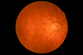 [OCT Article] Choroidal Neovascularization with Optovue Solix Image