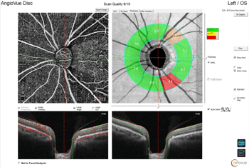 [OCT Article] Unraveling Green Disease with the Optovue Solix AngioVue Disc Report Image