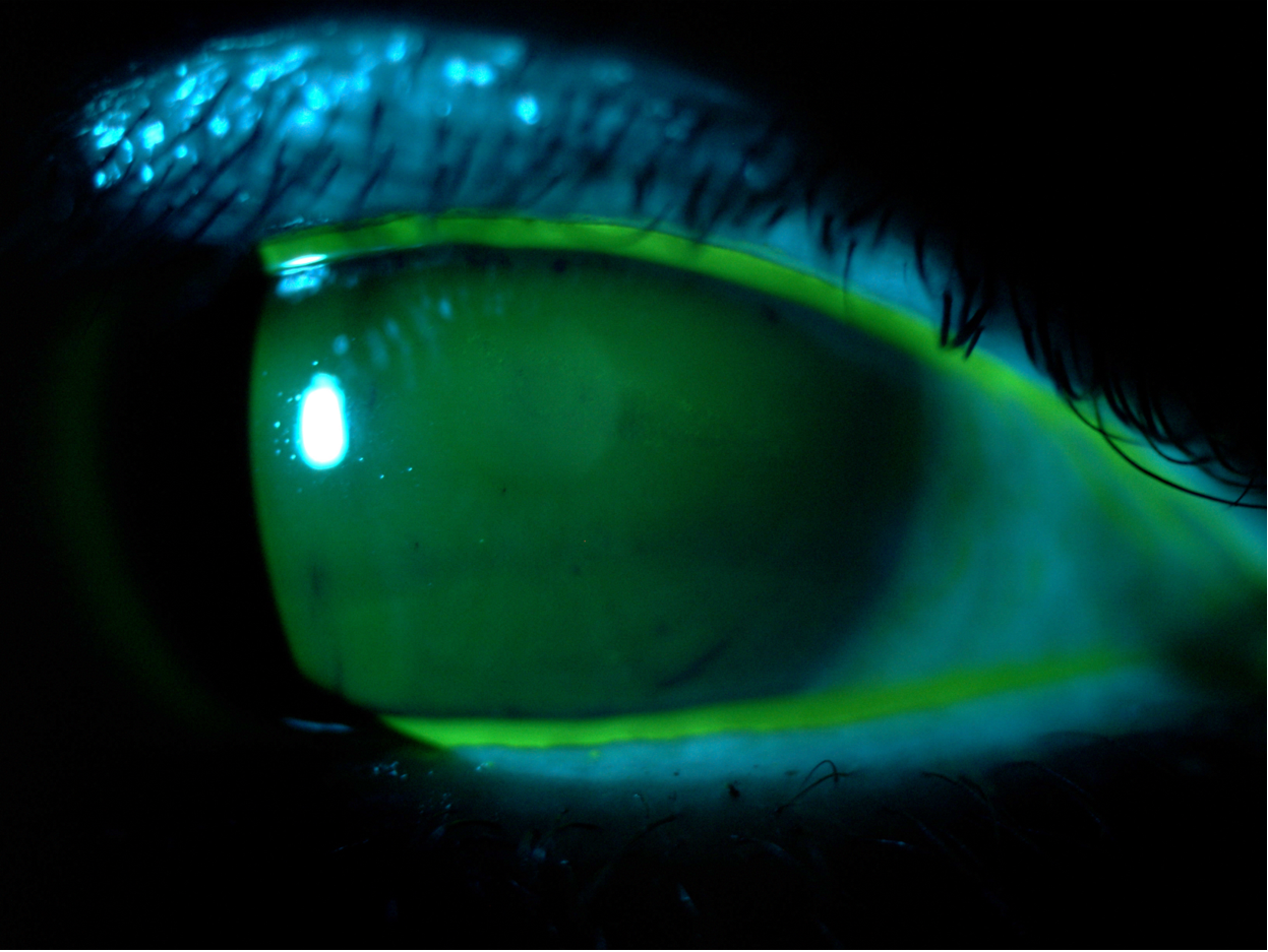 [OCT Article] Dry eye and irregular epithelial thickness map Image