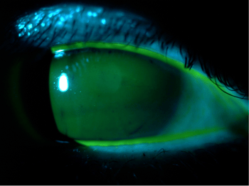 [OCT Artículo] Caso ojo seco y mapa de espesor epitelial irregular Image
