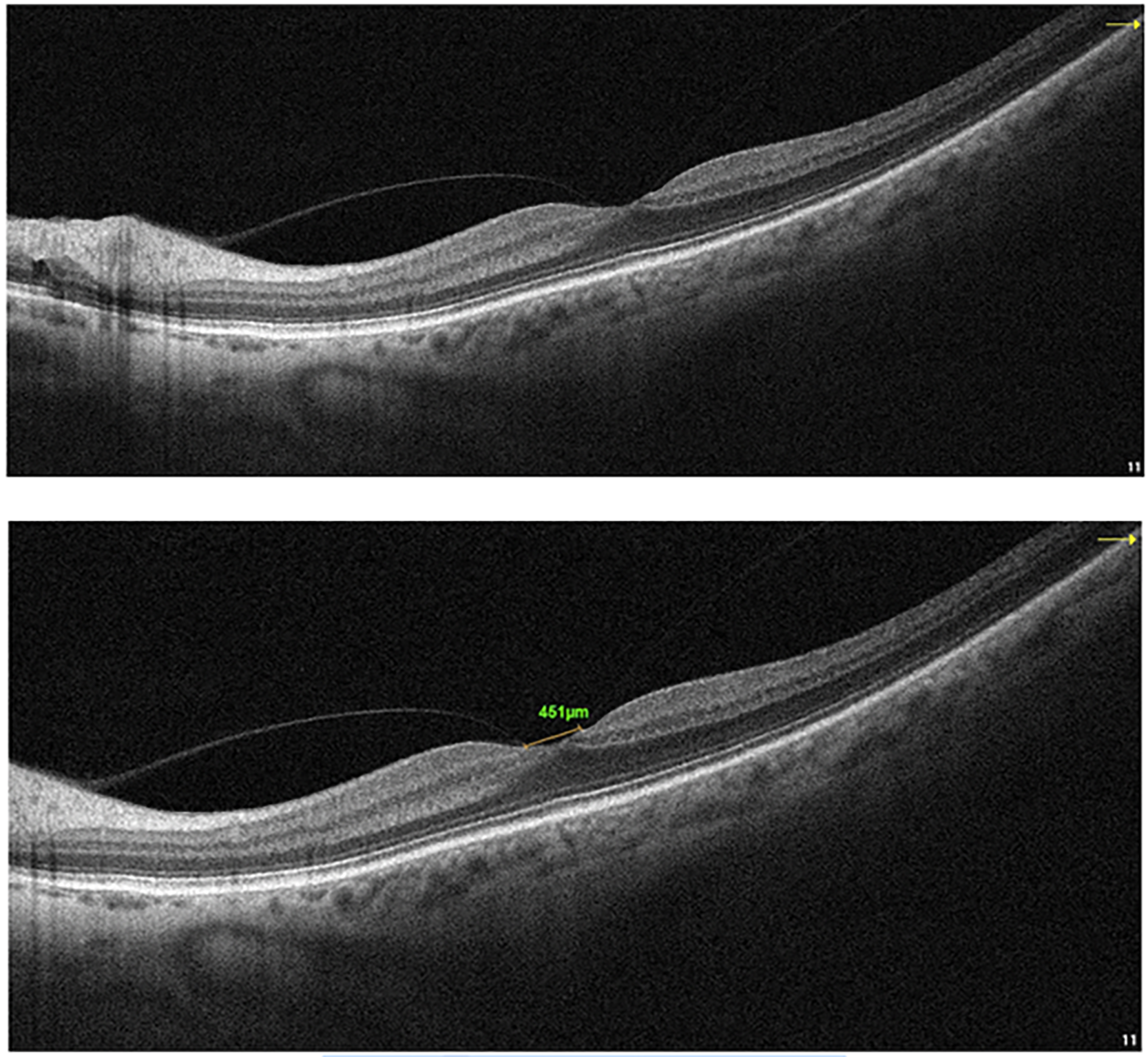 [OCT Article] Vitreous: Friend or Foe