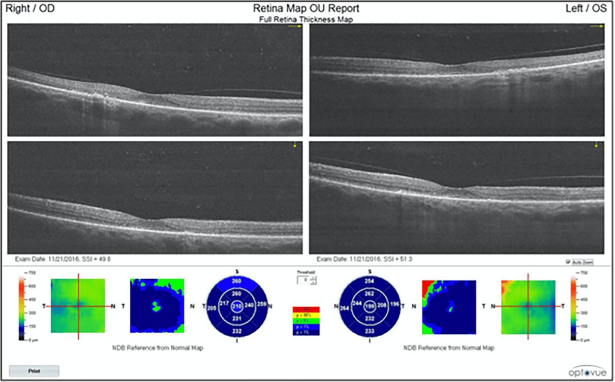 [OCT Artículo] Los cambios sutiles importan cuando se trata de ciertas condiciones de retina Image