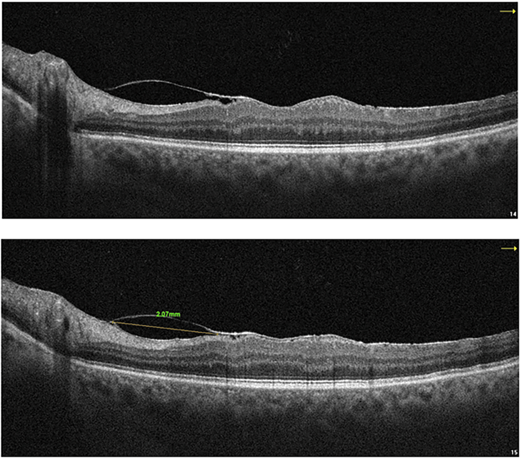 [OCT Article] Vitreous: Friend or Foe