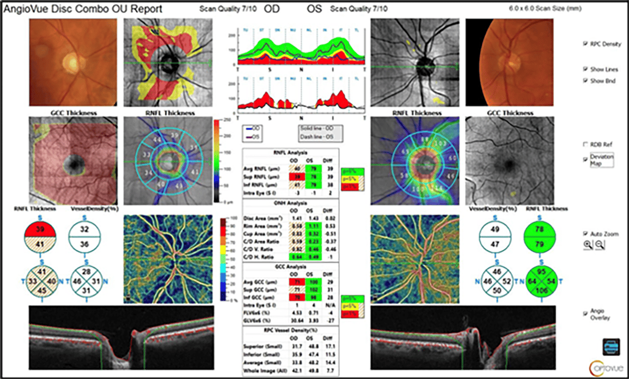 [OCT Artículo]El informe completo de AO para el tratamiento del glaucoma mejora la comprensión y la educación del paciente Image